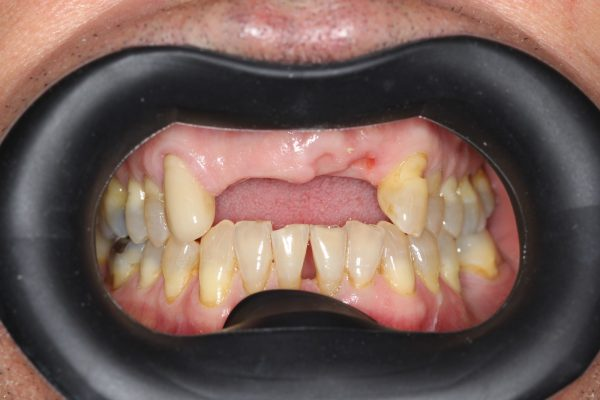 Missing upper front teeth before dental implant treatment in Guildford