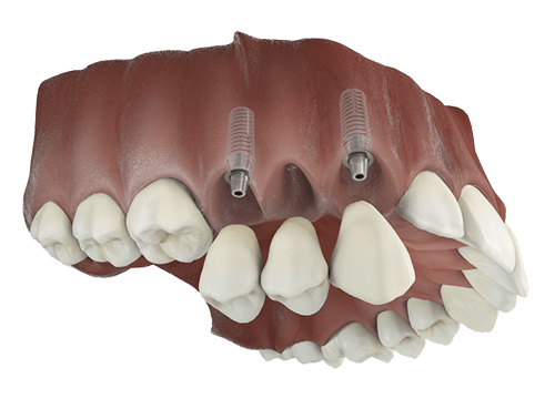 Multiple dental implants supporting an implant bridge