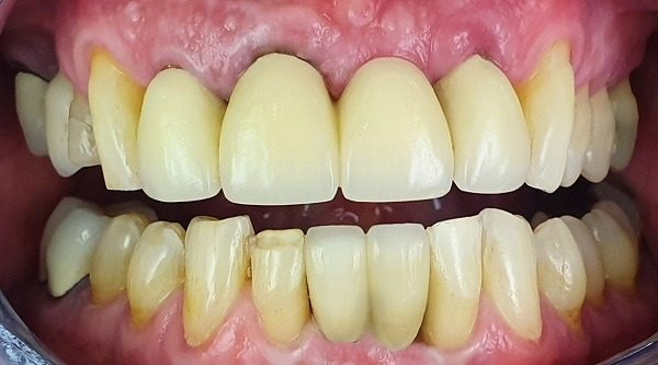 Lower front teeth restored with dental implants in Guildford