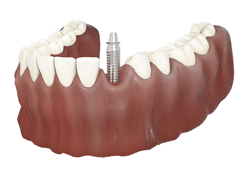 Single dental implant replacing one missing tooth