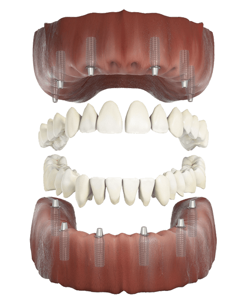 All-on-4 teeth in a day full arch dental implants