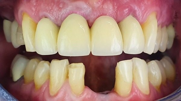 Missing lower front teeth before dental implant treatment in Guildford