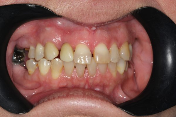 Upper tooth restored with a dental implant in Guildford